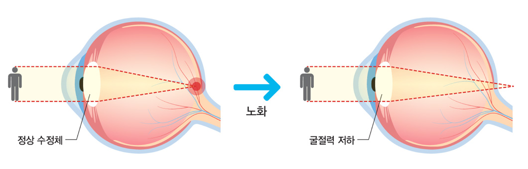 정상 수정체 노화 후 굴절력 저하