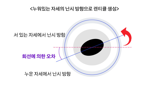 누워있는 자세의 난시 방향으로 렌티큘 생성
