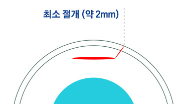 최소 절개 (약 2mm)