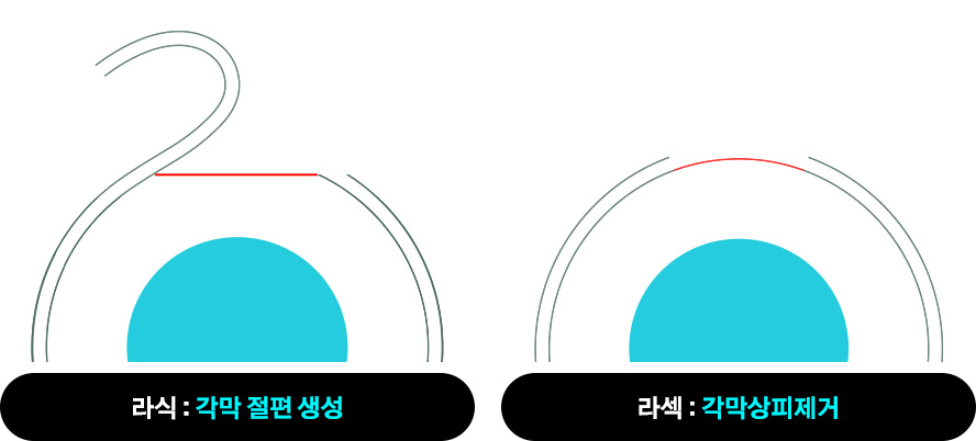 라식 : 각막 절편 생성 / 라섹 : 각막상피제거