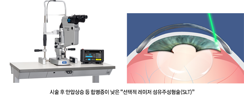 시술 후 안압상승 등 합병증이 낮은 '선택적 레이저 섬유주성형술(SLT)'