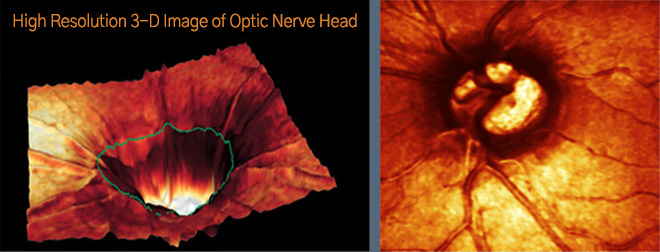 High Resolution 3-D Image of Optic Nverve Head