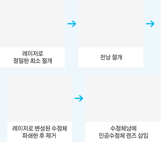 최소 절개 > 전낭 절개 > 레이저로 변셩된 수정체 파쇄한 후 제거 > 수정체낭에 인공수정체 렌즈 삽입